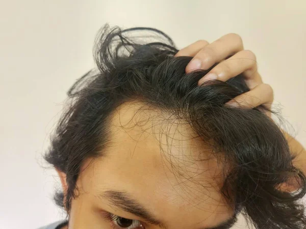 Muka Terguncang Dari Pria Asia Menjadi Botak Dan Kehilangan Rambut — Stok Foto