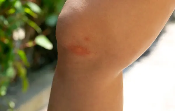 stock image Inflamed human skin after a mosquito bite outdoors. 