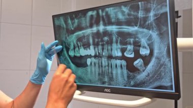 Diş hekiminin elleri diş incelemesi monitördeki ağız boşluğu röntgeni diş hekimliği bürosundaki hastaya terapiyi tarif ediyor. Ağız hijyenik ortodonti tedavisi, diş bakımının incelenmesi