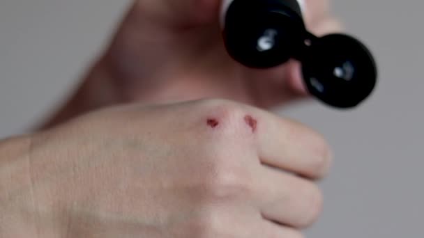 Woman Apply Cream Wound Hit Hand Fist Close Slow Motion — 图库视频影像