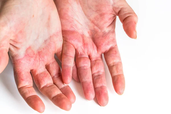 Dermatitis Atópica Manos Mujer Altamente Alérgicas Piel Roja Agrietada Problemas —  Fotos de Stock
