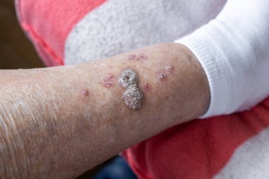 Ülser ve deri hastalıkları, kurumuş kabuklar ve yaşlı bir kadının bacaklarında taze yaralar, sağlık konsepti, bunama değişiklikleri, kapat.