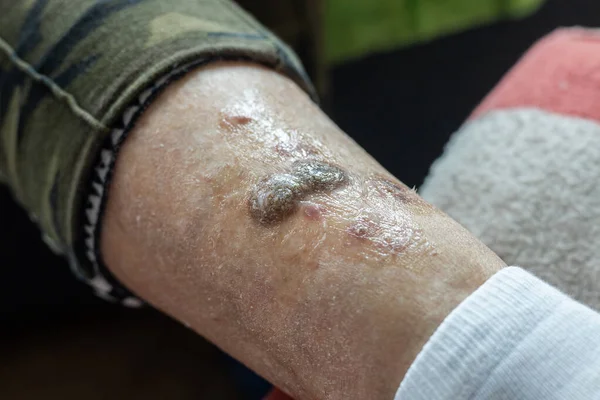 Язвы Кожные Заболевания Сушеные Струпья Свежие Раны Ногах Пожилой Женщины — стоковое фото