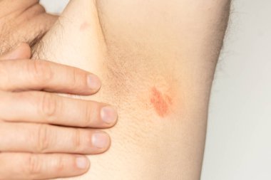 Kolların altındaki deri lezyonları, sağlık, hijyen ve deri hastalıkları kavramı