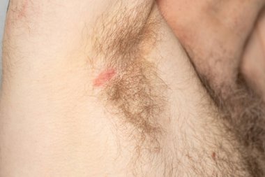 Önemsiz koltuk altları ve deri lezyonları, sağlık konsepti, hijyen ve deri hastalıkları.