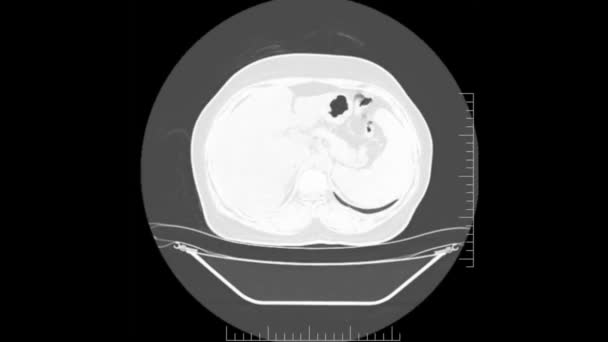 腹部大量Ct扫描 胃肠道 肝脏及肾脏的电脑断层扫描 — 图库视频影像