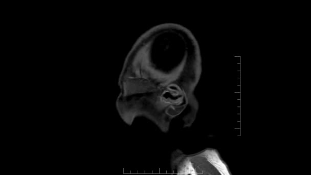Boyutlu Beyin Görünümü T1W Spir Sırası Mri Taraması — Stok video