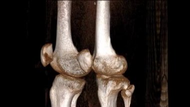 Diz ekleminin 3 boyutlu tomografisi Dönen Resim ve 2B Yay Görünümü Gelincik Kırığı Gösteriyor