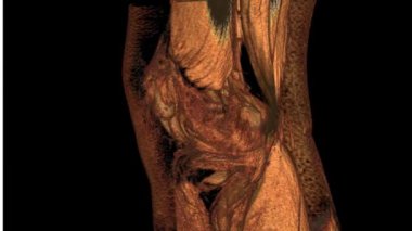 Sağ diz MRI 3D modeli