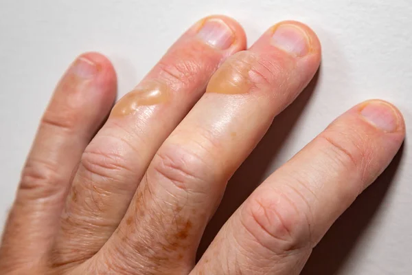 Kaynar yağdan dolayı ciltte tipik ikinci derece yanma kabarcıkları. İkinci derece yanık