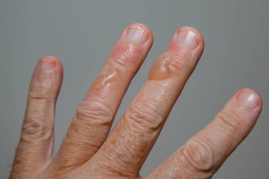 Tipik ikinci derece kaynar yağ yanığı kabarcıkları..