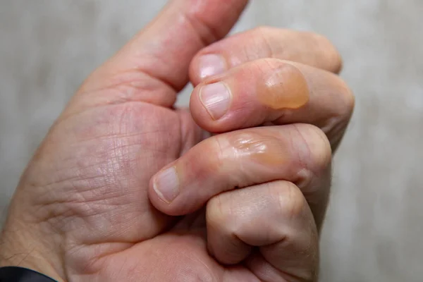 Tipik ikinci derece kaynar yağ yanığı kabarcıkları..