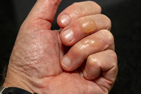 Tipik ikinci derece kaynar yağ yanığı kabarcıkları..