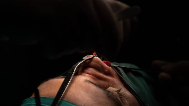 Burun estetiği ameliyatı, kadın hastada burun şeklindeki kusurlar. Estetik cerrahi burun estetiğine cerrahi müdahale 