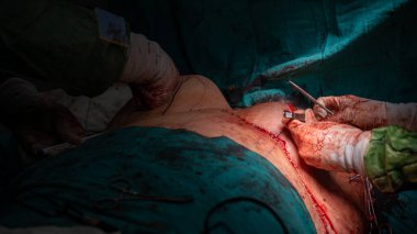 Estetik cerrah göğüs implantı yapan estetik cerrah ameliyathanesinde göğüs ameliyatı yapıyor. Göğüs büyütme ve küçültme ameliyatı