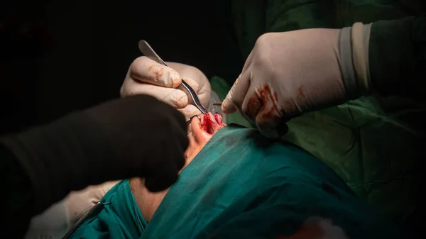 Cirurgia Rinoplastia Defeitos Forma Nariz Paciente Feminina Intervenção Cirúrgica Rinoplastia Imagem De Stock