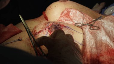 Göğüs implantı ameliyatı. Ameliyathanede kanlı göğüs implantı.