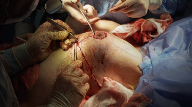 Göğüs implantı ameliyatı. Doktor, hemşireyle göğüs gerdirme ameliyatı yapıyor.