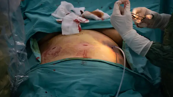 Laparoscopic surgery requires stitches after surgery. After the surgery, the doctor finishes the surgery by stitching