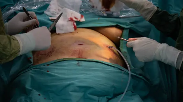 Laparoscopic surgery requires stitches after surgery. After the surgery, the doctor finishes the surgery by stitching
