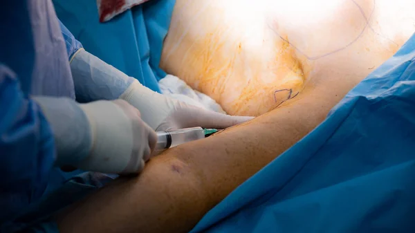 Doktor kol liposuction yapıyor. Çizim ve enjeksiyonlar yağ aldırmadan önce yapılır