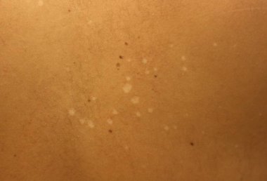 Rahatsız edici bir yakın çekim deri mantarının neden olduğu beyaz lekelerin varlığını ortaya çıkararak mantar enfeksiyonlarıyla ilgili rahatsızlığı ve endişeleri vurguluyor.