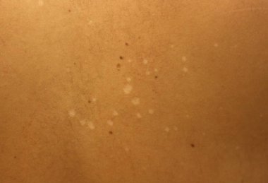 Rahatsız edici bir yakın çekim deri mantarının neden olduğu beyaz lekelerin varlığını ortaya çıkararak mantar enfeksiyonlarıyla ilgili rahatsızlığı ve endişeleri vurguluyor.