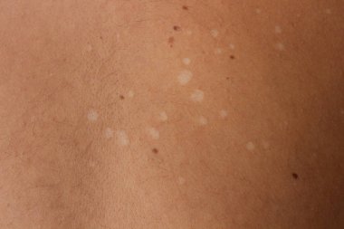 Tinea Versicolor 'un nüanslarını inceleyin, aynı zamanda pityriasis versicolor olarak da bilinir, deriyi etkileyen yaygın bir mantar enfeksiyonu.