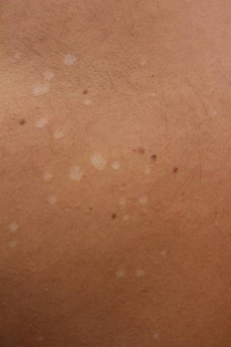 Tinea Versicolor 'un nüanslarını inceleyin, aynı zamanda pityriasis versicolor olarak da bilinir, deriyi etkileyen yaygın bir mantar enfeksiyonu.