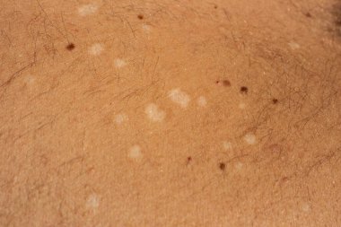 Yüksek çözünürlüklü stok görüntüsüyle Tinea Versicolor 'un, yaygın bir mantar derisi enfeksiyonunun görsel karmaşıklığını yakalayın.