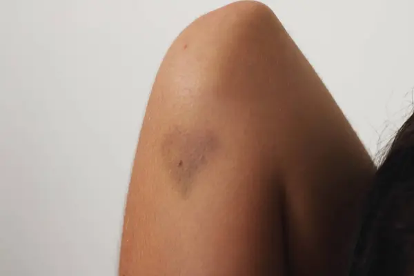 stock image A heart-shaped bruise on the arm of a young woman symbolizes the pain and impact of toxic relationships and gender violence.