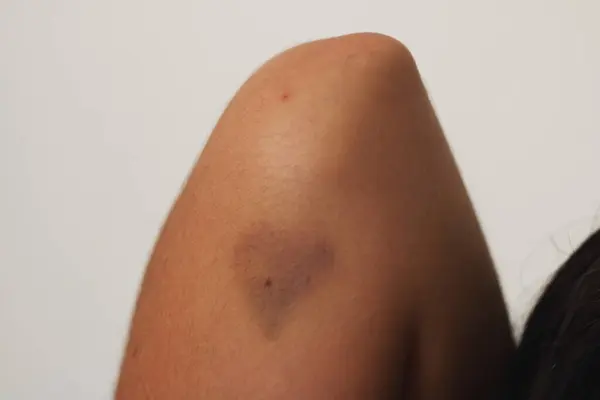 stock image A heart-shaped bruise on the arm of a young woman symbolizes the pain and impact of toxic relationships and gender violence.