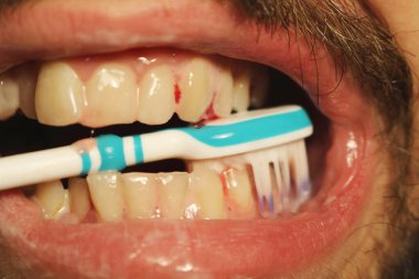 A close-up shot of a toothbrush brushing teeth, revealing bleeding gums often a symptom of gingivitis or periodontitis. This striking image emphasizes the importance of maintaining proper oral hygiene and seeking timely dental care. clipart