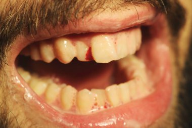 A close-up shot of a toothbrush brushing teeth, revealing bleeding gums often a symptom of gingivitis or periodontitis. This striking image emphasizes the importance of maintaining proper oral hygiene and seeking timely dental care. clipart