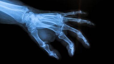X-ışını insan kemik