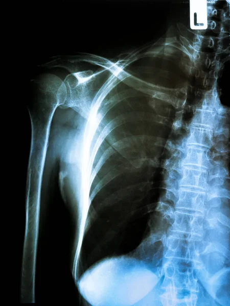 x-ray of spine, medical scan.