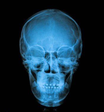 human skull with x-ray image