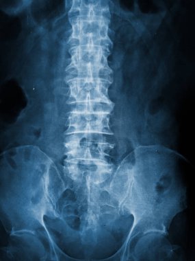 Patient was operated and internal fixed