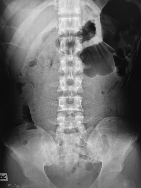 x-ray of human spine