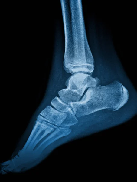 human foot bones and knee pain, x-ray