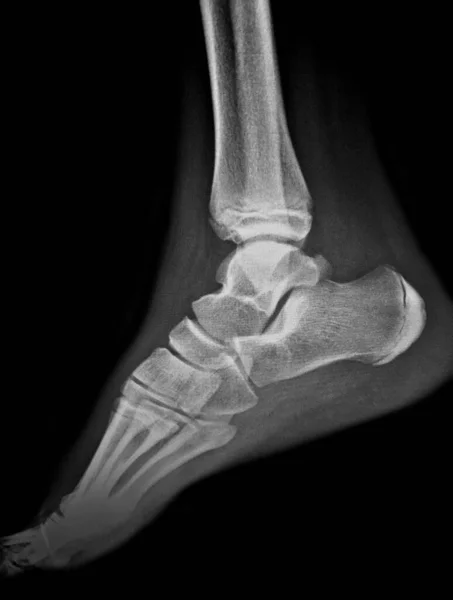 human foot pain, x-ray scan