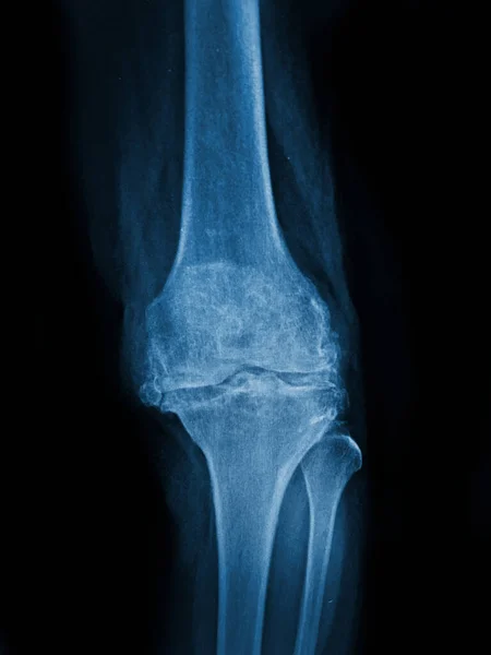 Film x-ray  knee with arthritis of knee joint