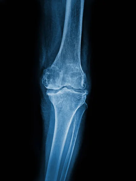Film x-ray  knee with arthritis of knee joint