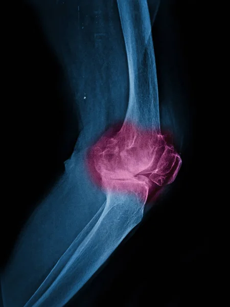 Osteoarthritis knee . film x-ray knee ( anterior - posterior and lateral view )