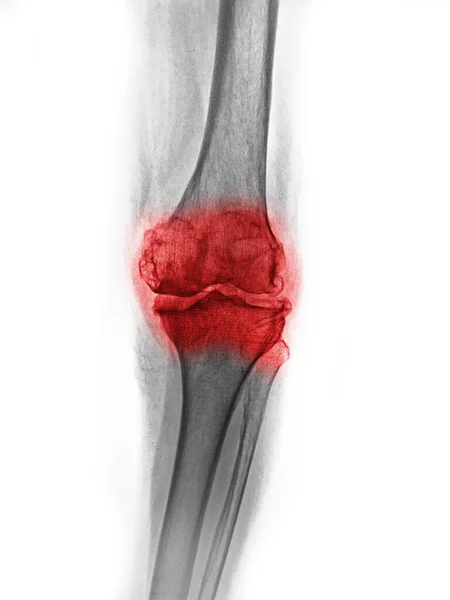 Osteoarthritis knee . film x-ray knee ( anterior - posterior and lateral view )
