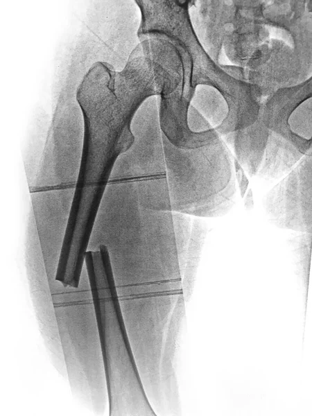 X-ray femur show complete fracture shaft of femur and displace