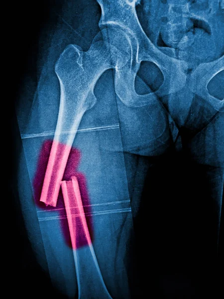 X-ray femur show complete fracture shaft of femur and displace