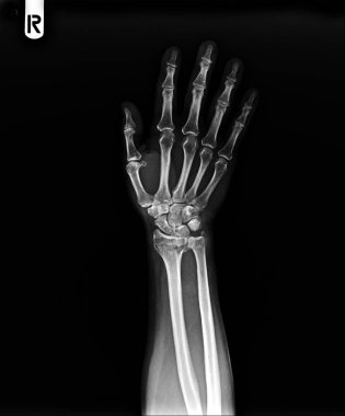 human hand in x-ray of joint on black background