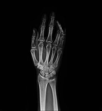 human hand with x-ray image