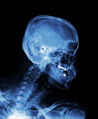 insan kafatası x-ray